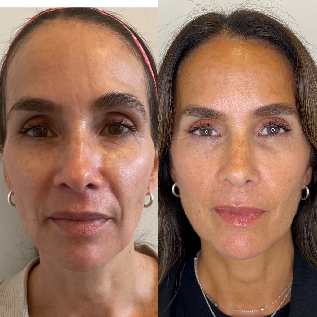 Morpheus8 Skin Resurfacing & Rejuvenation by KOZA Skin Clinic
