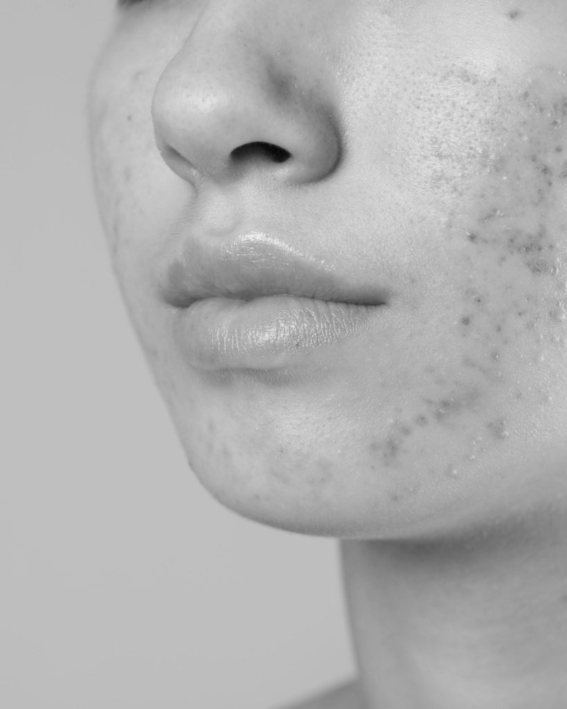 Acne treatment by KOZA Skin Clinic