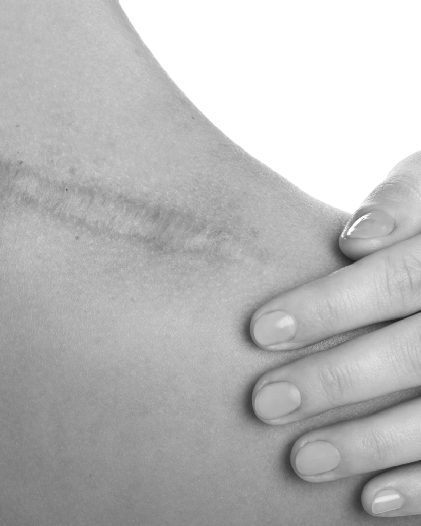 Body Scars treatment by KOZA Skin Clinic