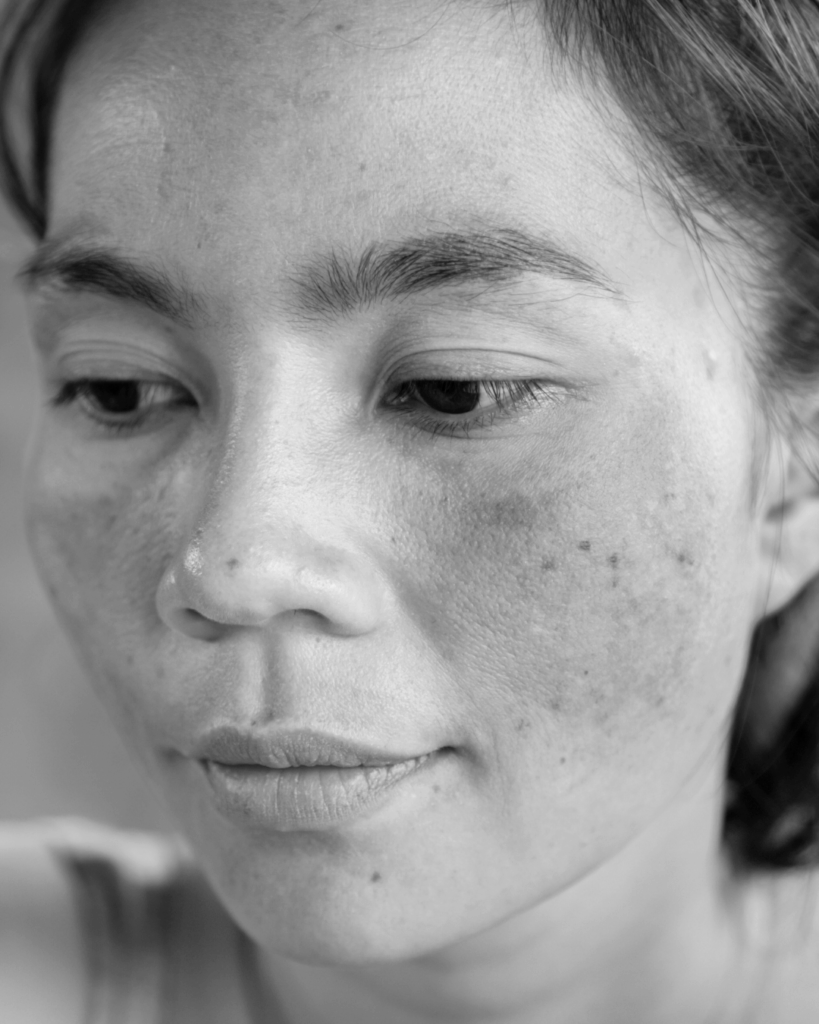 Melasma treatment by KOZA Skin Clinic