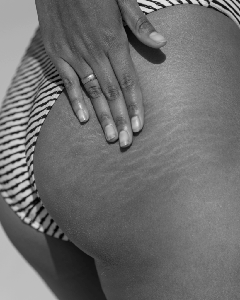 Stretch Marks treatment by KOZA Skin Clinic