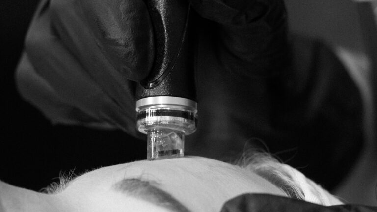 Hydrafacial Port Coquitlam Port Moody Vancouver KOZA Skin Clinic