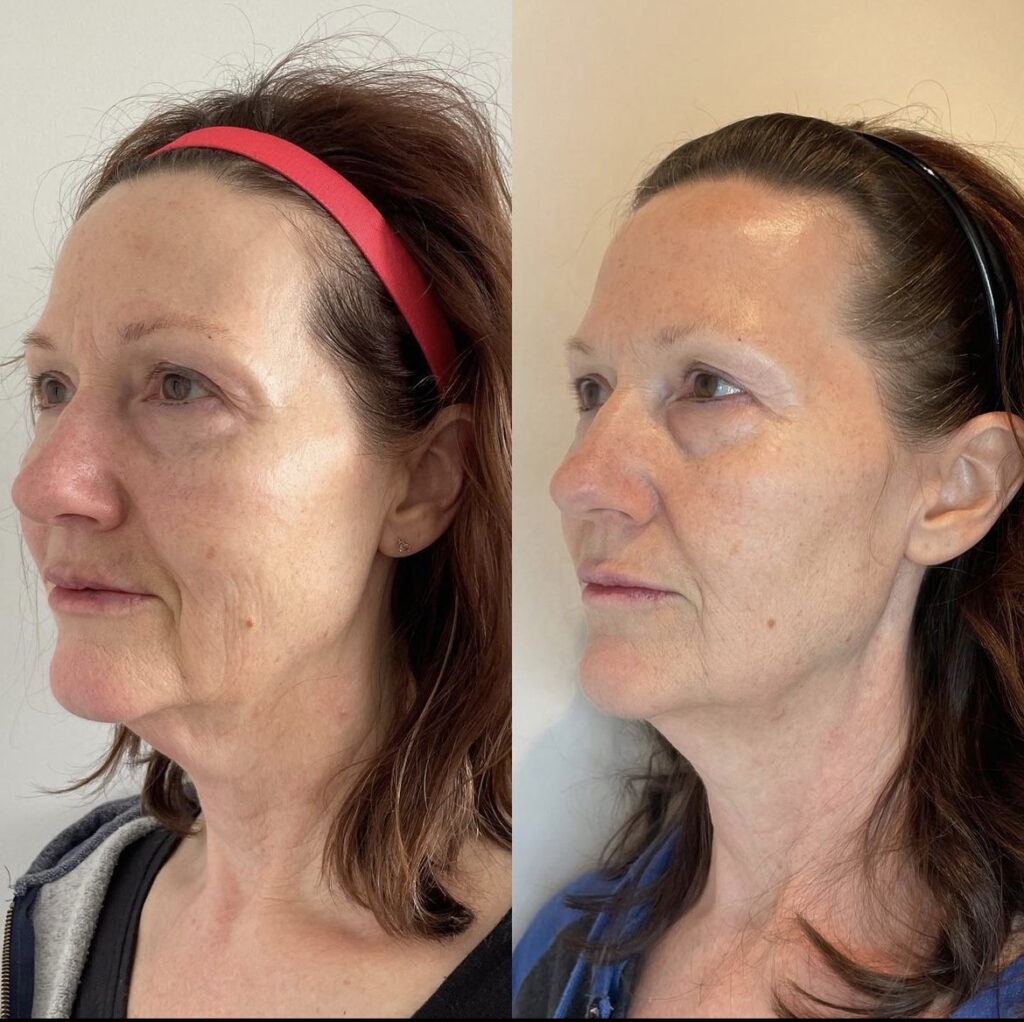 Morpheus8 RF Radio Frequency Microneedling Results Before and After Port Coquitlam Port Moody Vancouver KOZA Skin Clinic