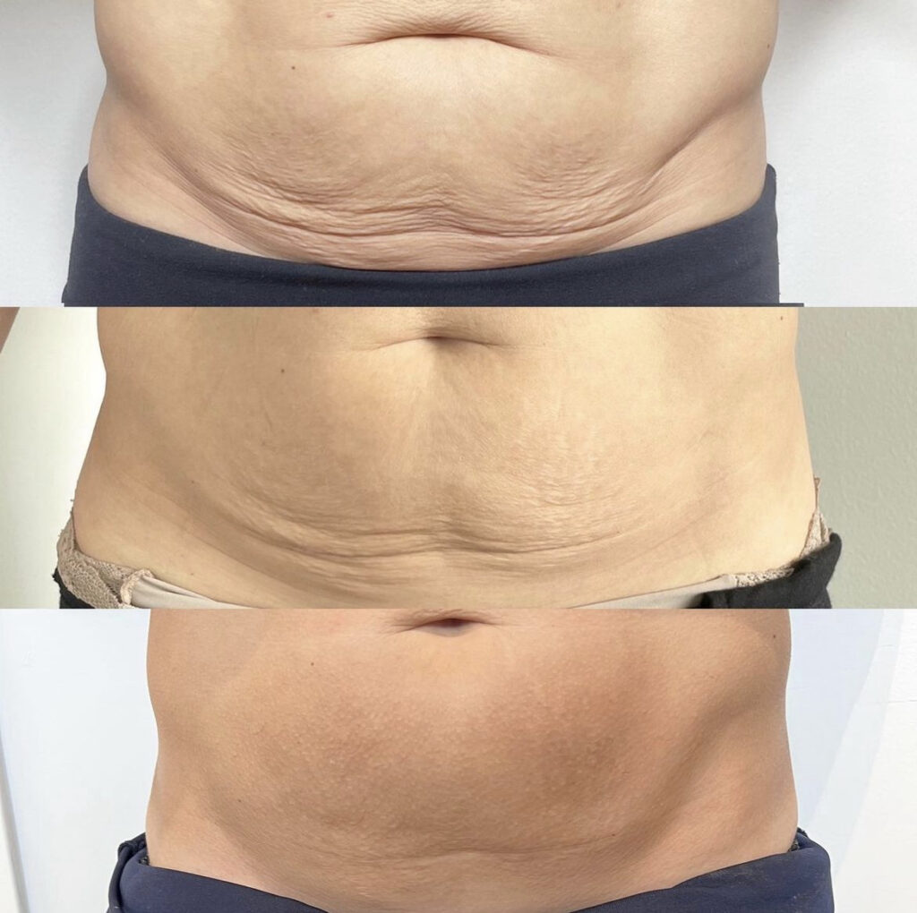 Morpheus8 RF Radio Frequency Microneedling Results Before and After Port Coquitlam Port Moody Vancouver KOZA Skin Clinic