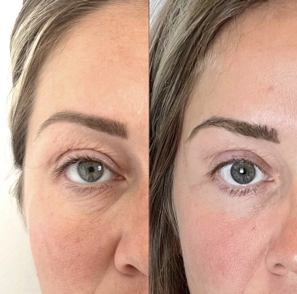 Morpheus8 RF Radio Frequency Microneedling Results Before and After Port Coquitlam Port Moody Vancouver KOZA Skin Clinic