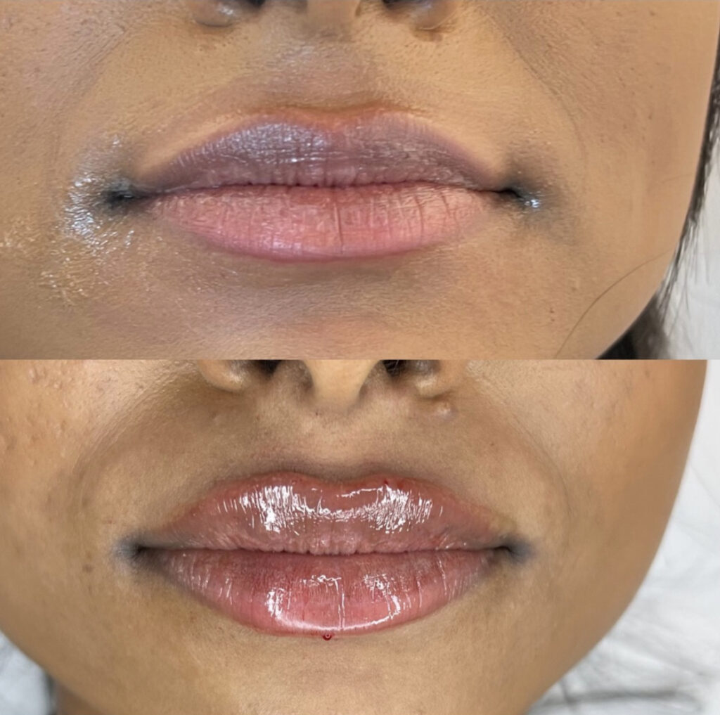 Lip Filler Russian Lips Results Before and After Port Coquitlam Port Moody Vancouver KOZA Skin Clinic