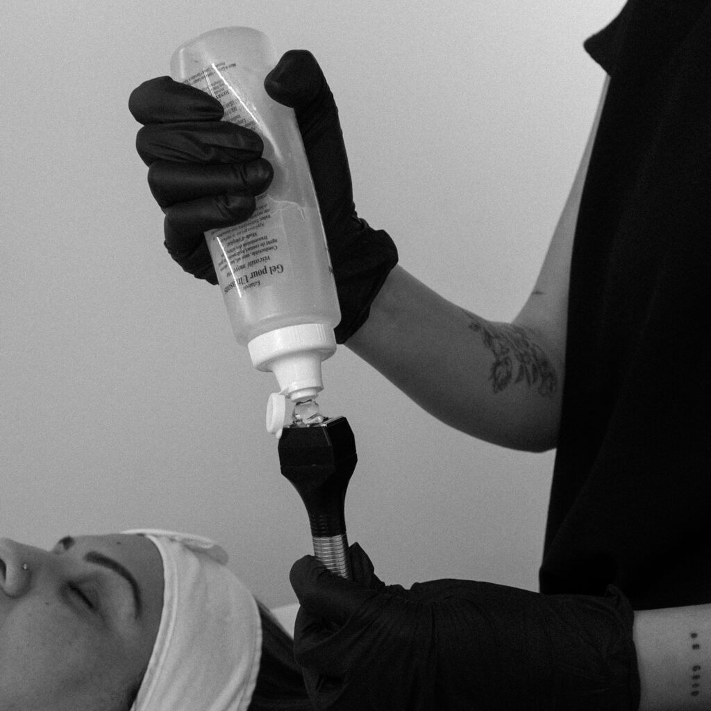 InMode Forma RF Radiofrequency Skin Tightening Port Coquitlam Port Moody Vancouver KOZA Skin Clinic