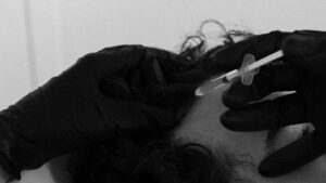 PRP Hair Restoration Port Coquitlam Port Moody Vancouver KOZA Skin Clinic