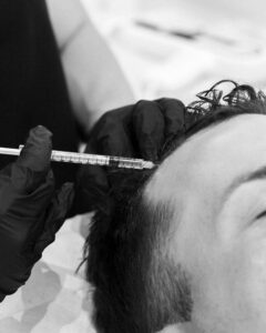 PRP Hair Restoration Port Coquitlam Port Moody Vancouver KOZA Skin Clinic