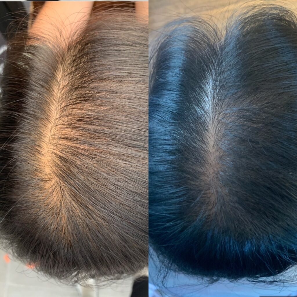 PRP Hair Restoration Before and After Port Coquitlam Port Moody Vancouver KOZA Skin Clinic