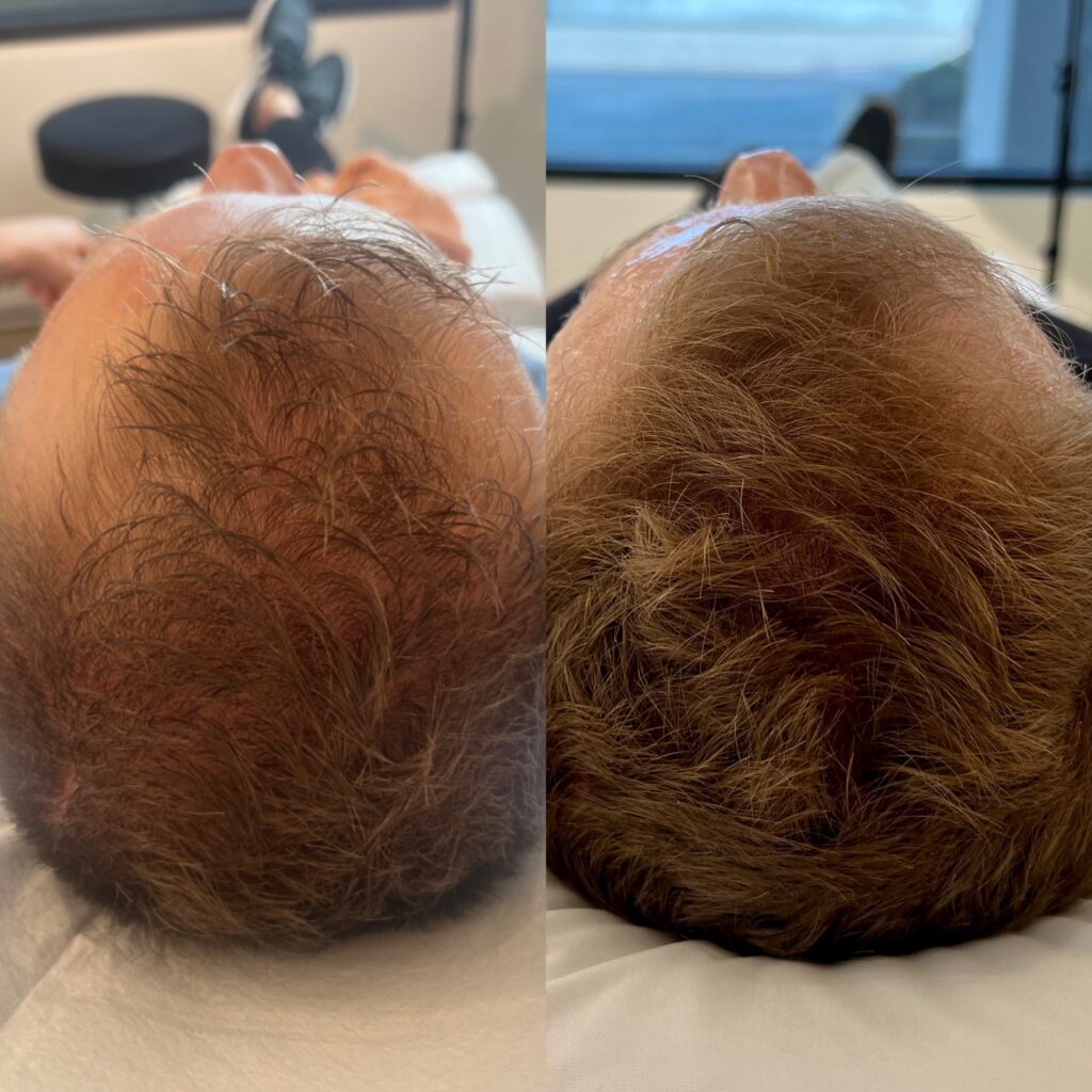 PRP Hair Restoration Before and After Port Coquitlam Port Moody Vancouver KOZA Skin Clinic