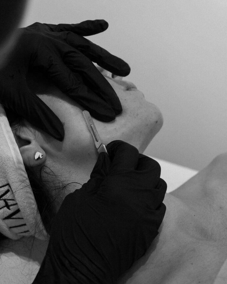 Dermaplaning Facial Hair Removal Port Coquitlam Port Moody Vancouver KOZA Skin Clinic