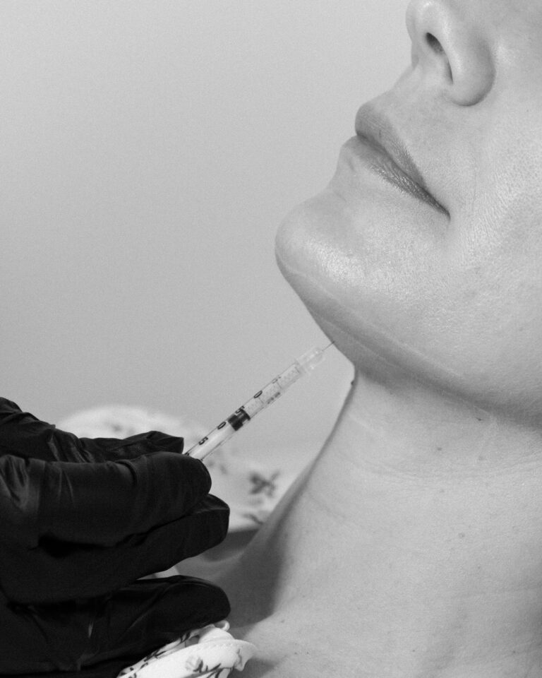 Fat Dissolve DCA Deoxycholic Acid Kybella Belkyra Lipodissolve Liquid Lipo Port Coquitlam Port Moody Vancouver KOZA Skin Clinic