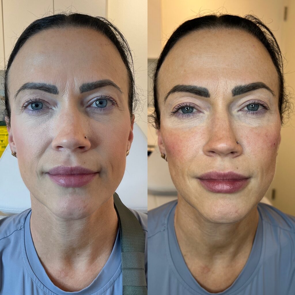Dermal Filler Hyaluronic Acid Filler Port Coquitlam Port Moody Vancouver KOZA Skin Clinic