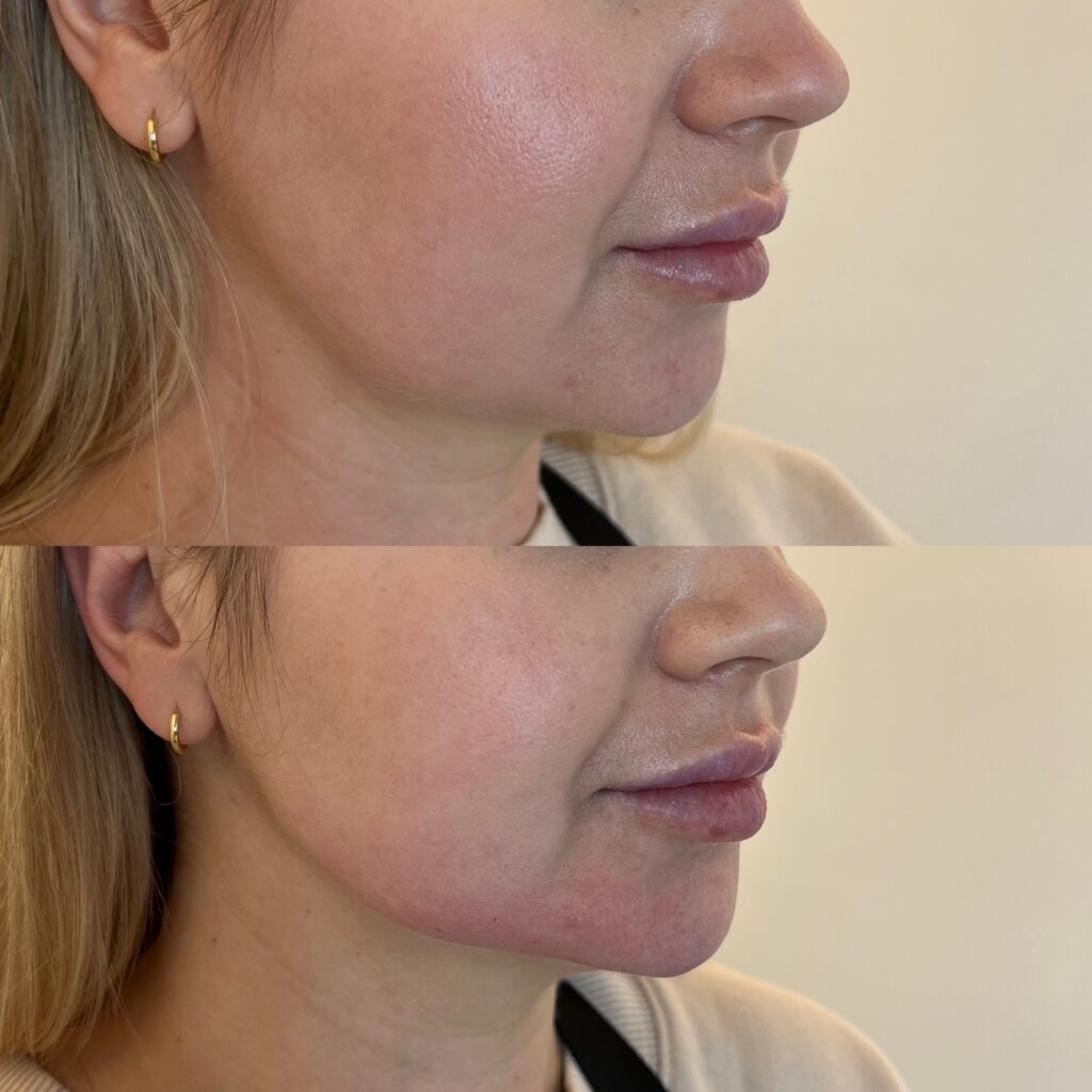 Dermal Filler Hyaluronic Acid Filler Port Coquitlam Port Moody Vancouver KOZA Skin Clinic