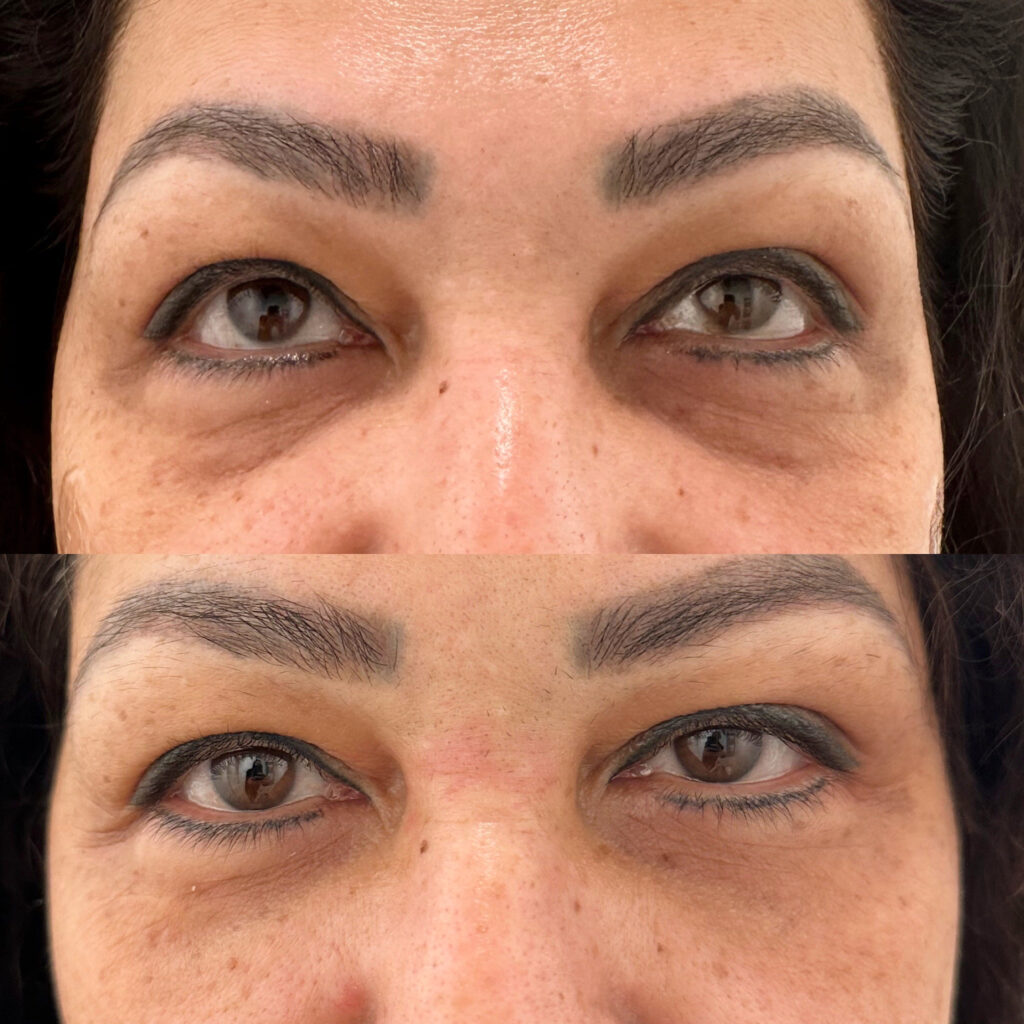 Dermal Filler Hyaluronic Acid Filler Port Coquitlam Port Moody Vancouver KOZA Skin Clinic
