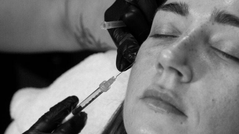 Light Eyes PRP Evangeline Bio Filler PRF Results Port Coquitlam Port Moody Vancouver KOZA Skin Clinic