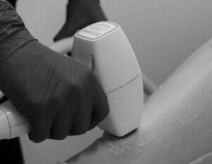 Laser Hair Removal LHR Port Coquitlam Port Moody Vancouver KOZA Skin Clinic