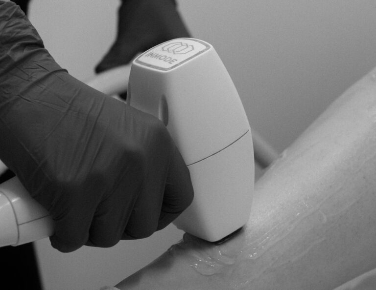 Laser Hair Removal LHR Port Coquitlam Port Moody Vancouver KOZA Skin Clinic