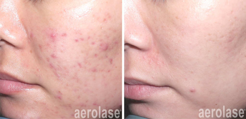 Acne Laser Treatment Aerolase Neo Elite NeoSkin NeoClear NdYAG Laser 1064 Port Coquitlam Port Moody Vancouver KOZA Skin Clinic