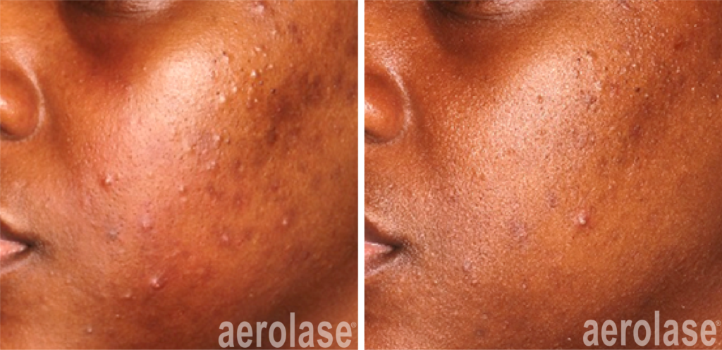 Acne Laser Treatment Aerolase Neo Elite NeoSkin NeoClear NdYAG Laser 1064 Port Coquitlam Port Moody Vancouver KOZA Skin Clinic