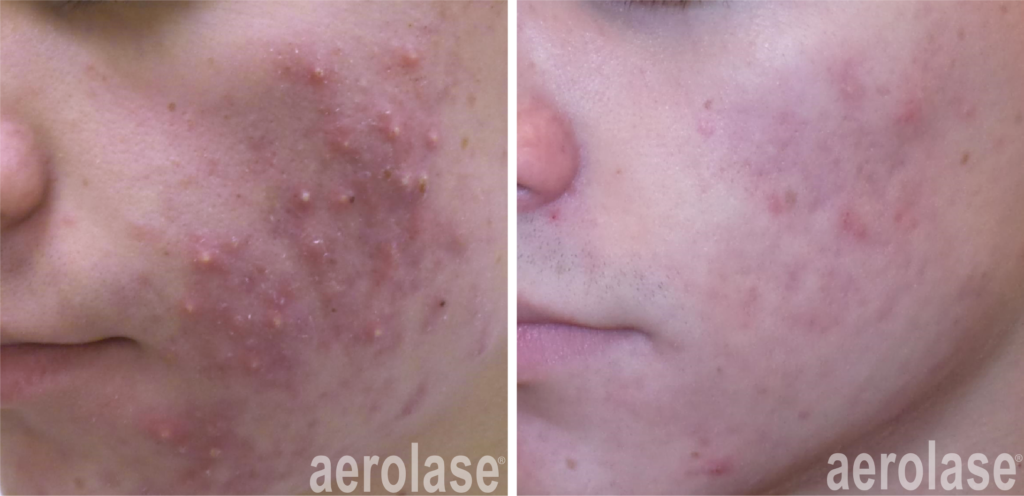 Acne Laser Treatment Aerolase Neo Elite NeoSkin NeoClear NdYAG Laser 1064 Port Coquitlam Port Moody Vancouver KOZA Skin Clinic