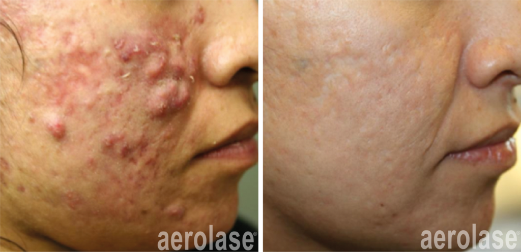 Acne Laser Treatment Aerolase Neo Elite NeoSkin NeoClear NdYAG Laser 1064 Port Coquitlam Port Moody Vancouver KOZA Skin Clinic