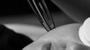 Laser for Melasma, Laser for Dark Spots on Dark Skin Aerolase Neo Elite NeoSkin NeoClear Port Coquitlam Port Moody Vancouver New West New Westminster KOZA Skin Clinic
