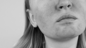 Treating Rosacea Best treatment for rosacea Port Coquitlam Port Moody Vancouver KOZA Skin Clinic
