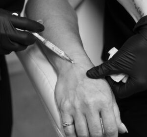 Radiesse for Hands, Hand Filler Port Coquitlam Port Moody Vancouver KOZA Skin Clinic