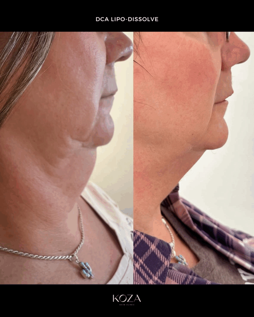 Lipo Dissolve Fat Dissolving Injection Transformation by KOZA Skin Clinic