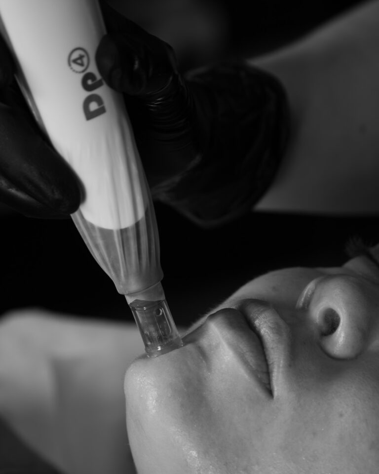 DermaPen DP4 Microneedling Port Coquitlam Port Moody Vancouver KOZA Skin Clinic